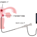 現在の画像に代替テキストがありません。ファイル名: 子宮鏡検査.png